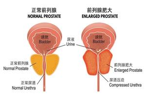 绥化前列腺肥大(前列腺增生肥大能治好吗)